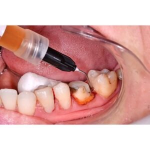 SafeEndo Smart Retract Liquid Hemostatic Agent - 15ml